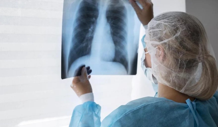 Tuberculosis